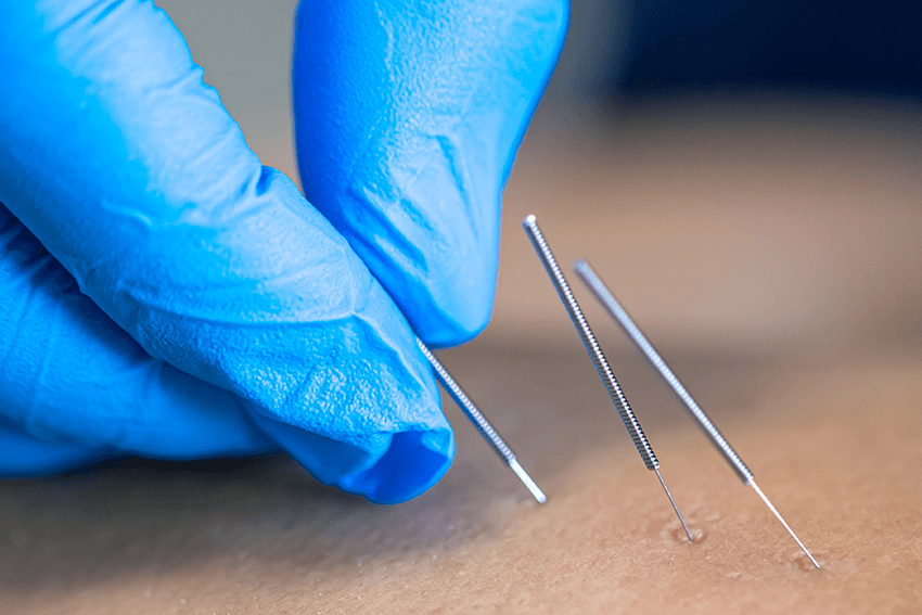 acupuncture needles