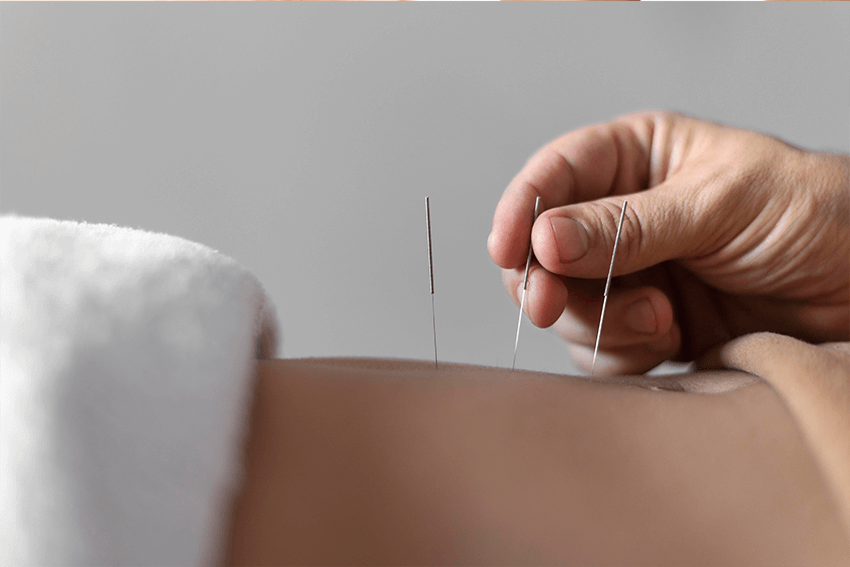 acupuncture